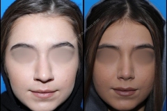 nose-surgery-0285