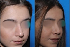 nose-surgery-0286