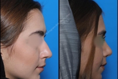 nose-surgery-0287