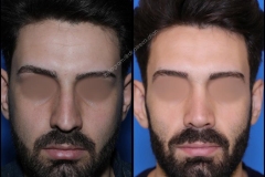 nose-surgery-0288