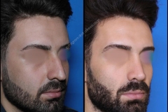 nose-surgery-0289