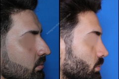 nose-surgery-0290