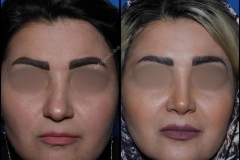 nose-surgery-0291