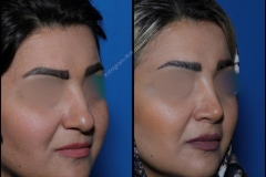 nose-surgery-0292