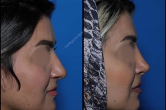 nose-surgery-0293