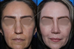 nose-surgery-0294