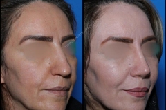 nose-surgery-0295