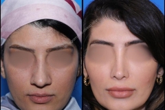 nose-surgery-0296