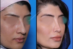 nose-surgery-0297