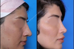 nose-surgery-0298