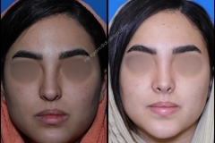 nose-surgery-0299