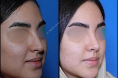 nose-surgery-0300
