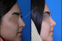 nose-surgery-0301