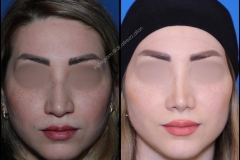 nose-surgery-0302