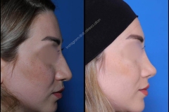 nose-surgery-0303