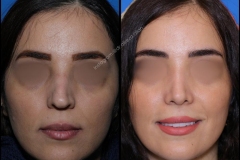 nose-surgery-0304