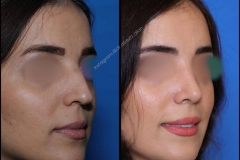nose-surgery-0305