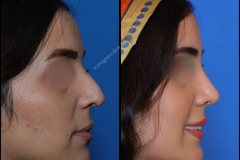 nose-surgery-0306