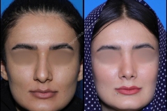 nose-surgery-0307