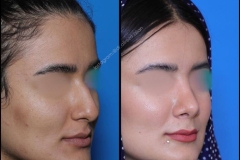 nose-surgery-0308