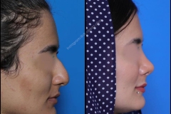 nose-surgery-0309