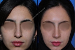 nose-surgery-0310