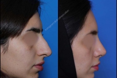 nose-surgery-0311
