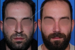 nose-surgery-0312
