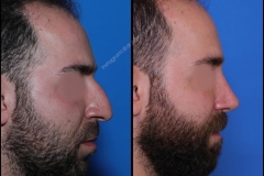 nose-surgery-0313