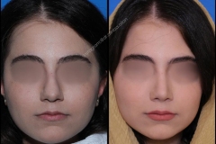 nose-surgery-0314