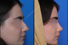 nose-surgery-0315