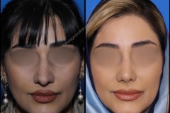 nose-surgery-0316