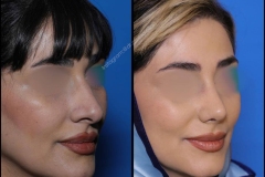 nose-surgery-0317