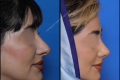 nose-surgery-0318