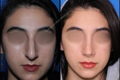 nose-surgery-0319