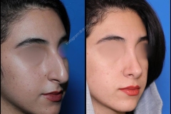 nose-surgery-0320