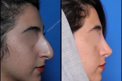 nose-surgery-0321