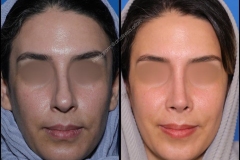 nose-surgery-0322
