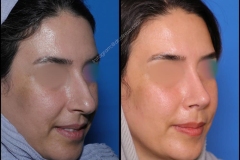 nose-surgery-0323