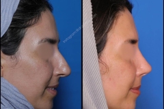 nose-surgery-0324