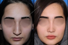 nose-surgery-0325
