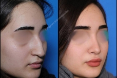 nose-surgery-0326