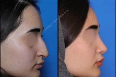nose-surgery-0327
