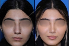 nose-surgery-0328