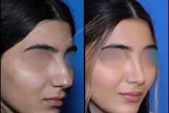 nose-surgery-0329