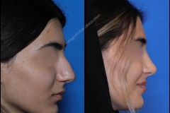 nose-surgery-0330