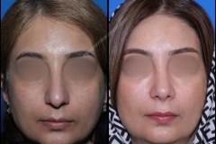 nose-surgery-0331