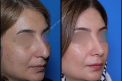 nose-surgery-0332