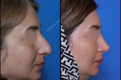 nose-surgery-0333