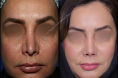 nose-surgery-0334